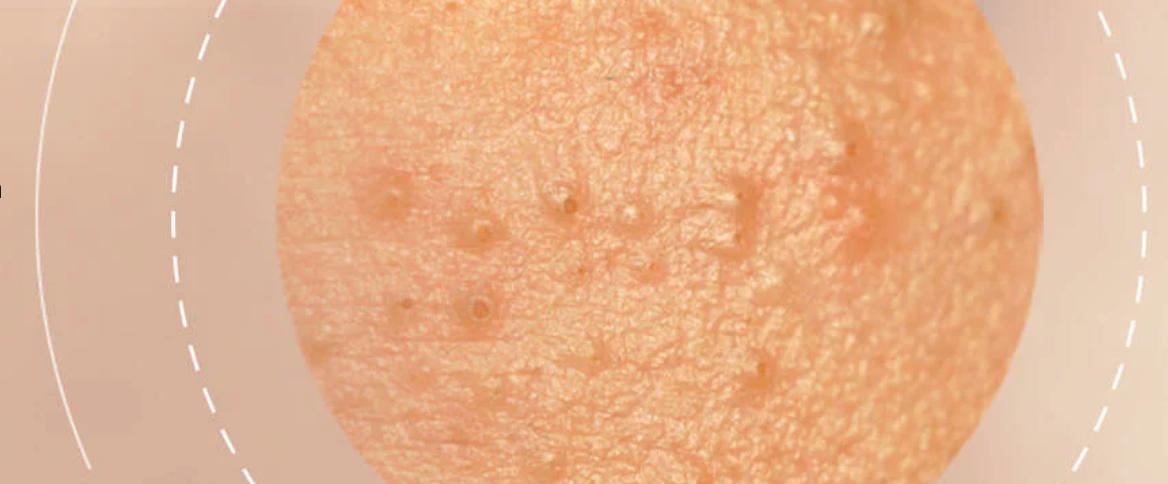 Adult Acne